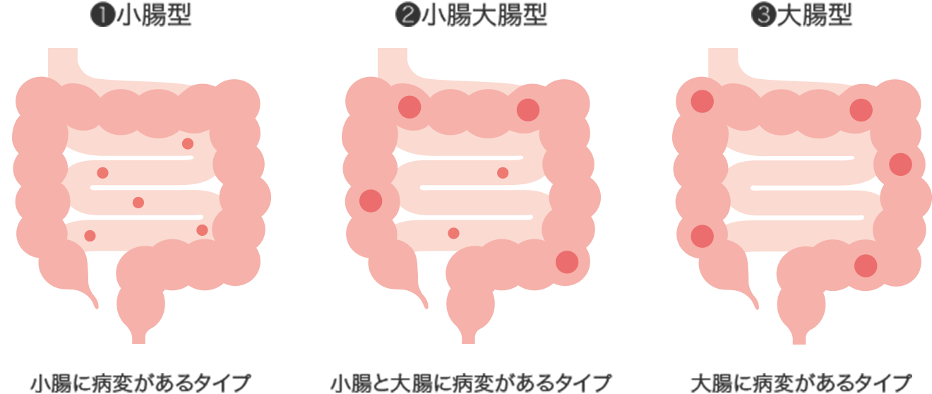 瘻孔を伴うクローン病の診断