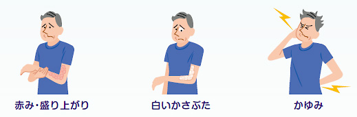 乾癬の症状